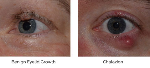 Benign Eyelid and Eye Growths > Fact Sheets > Yale Medicine