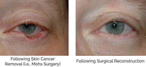 Eyelid Reconstruction