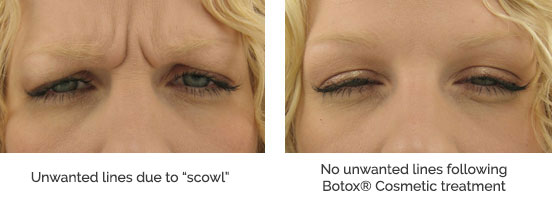 Before and After Botox Injections